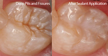 Pit & Fissure Sealants